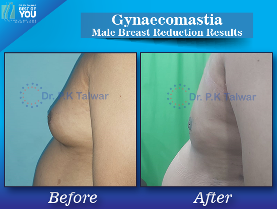 Gynaecomastia before after image